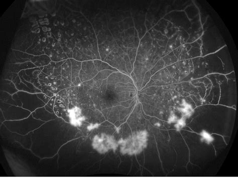Retinal Ischemia Retina Image Bank