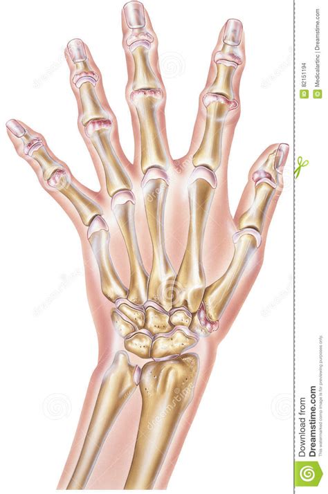 Hand Rheumatoid Arthritis Of The Joints Stock Illustration Illustration Of Joints Finger