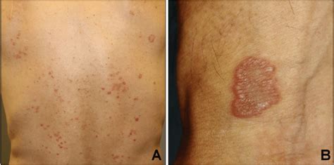 A Multiple Disseminated Erythematous Papules And Plaques On The Back