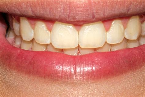 White Spot Lesions Orthodontics