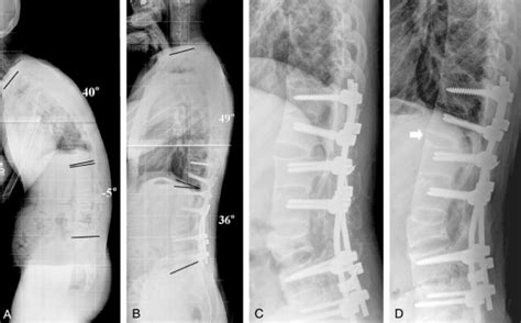 Spinal Osteotomy Manhattan Spine Consultants