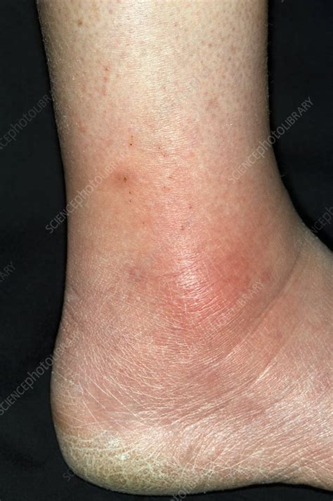 Allergy To Insect Bite On The Ankle Stock Image C0083602 Science