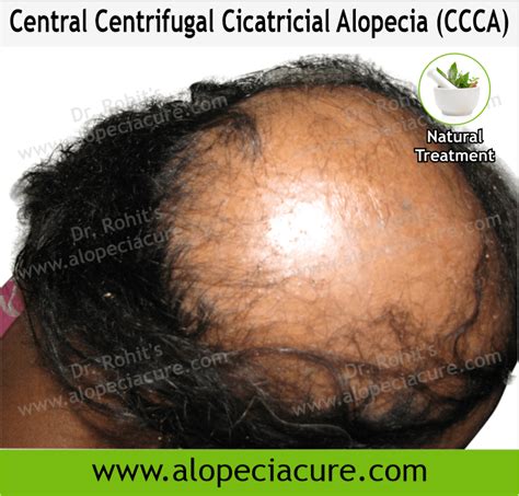 Scarring Alopecia Cicatricial Alopecia Treatment And Types