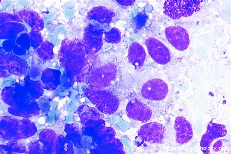 Squamous Cell Carcinoma Hematomorphology A Databank Imagebank For