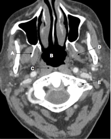 Computed Tomography Of The Neck The Bmj