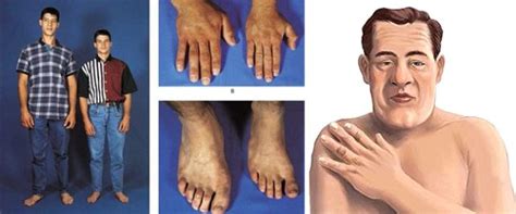 What Is Acromegaly Causes Symptoms And Treatment