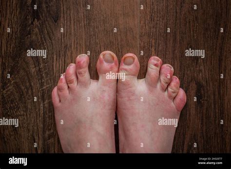 Feet Of Person With Raynauds Phenomenon With Red Swollen Toes And