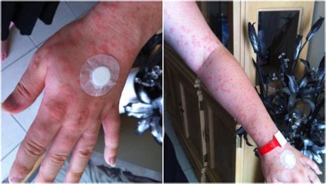 Pregnant Mums Rash Covered Her Whole Body ‘the Pain And The Itch Was