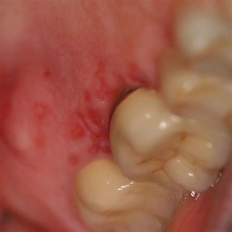 Recurrent Aphthous Ulcer Located On The Ventrolateral Tongue A