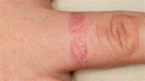 Contact Dermatitis Causes Symptoms And Treatment