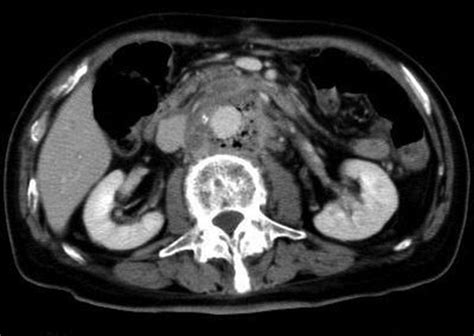 The Contrast Enhanced Ct Image Of Saef Patient No 7 The Presence Of