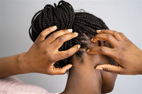 Dry Scalp What Causes A Flaky Itchy Scalp Here S How To Treat And