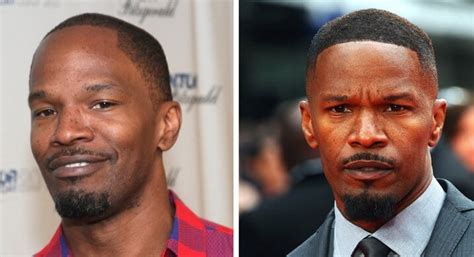Jamie Foxx Hairline Surgery Before And After Photos