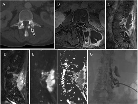 Septic Facet Arthropathy With Large Paraspinal Abscess Axial Ct Image