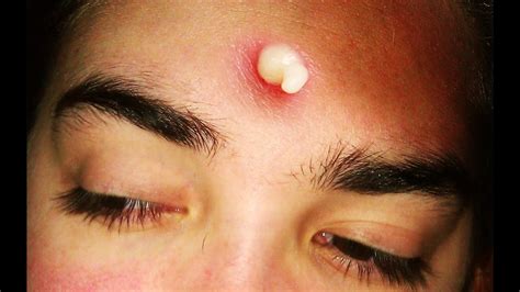 Pimple Zits Blackhead And Whitehead Causes Youtube