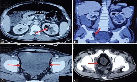 Emphysematous Cystitis A Case Report And Literature Review