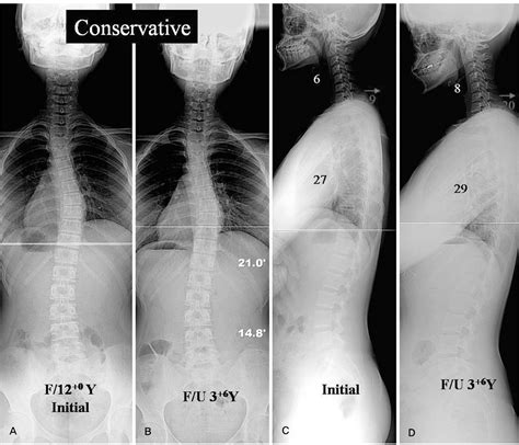 Specific Sagittal Curve Patterns Of Cervical Spine In Adolescent