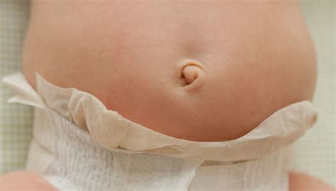 Postpartum Umbilical Hernia Umbilical Hernia Diastasi