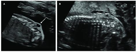 Ultrasound Image A Meningocele At L4 B Low Lying Conus Medullaris