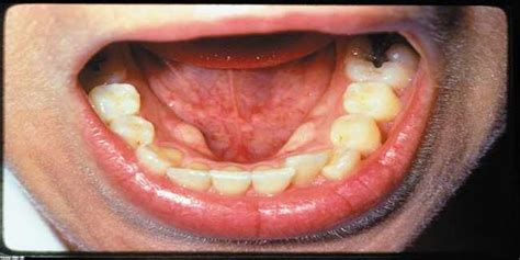 Oral Cancer Is Caused By Chewing Tobacco Or Tobacco国际蛋蛋赞