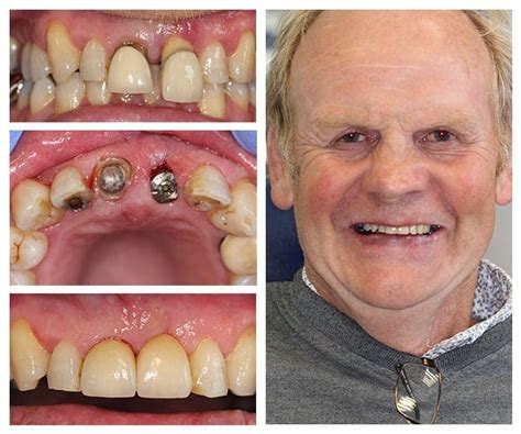 Denture Alternative Same Day Full Mouth Dental Implants Preston