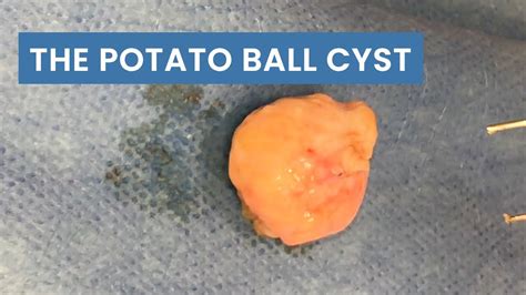 The Potato Ball Cyst Whole Sac Removed Pimplepoppingtv