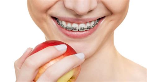 maneras de mantener la higiene dental con ortodoncia Clínica Dental NoemiDent