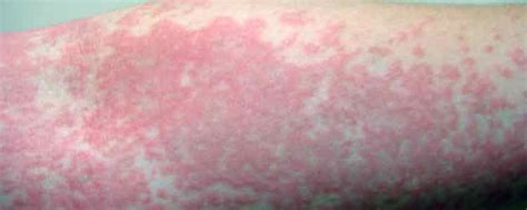 Apr 07, 2020 · hives appear as wheals (swellings) on the skin, sometimes pink or red and surrounded by a red blotch. The Top 8 Natural Remedies for Hives ...