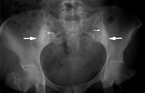 Sacroiliac Joint Dysfunction X Ray