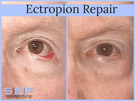 Ectropion And Entropion Treatment Long Island Schlessinger Eye