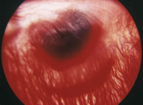 Pathogenesis Of The Vitreous Cloud Emanating From Subretinal Hemorrhage