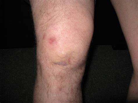 Mike Estes At Bruised Knee Cap In Hood River Oregon United States