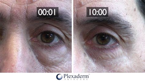 How To Remove Wrinkles And Under Eye Bags With Plexaderm™ Youtube