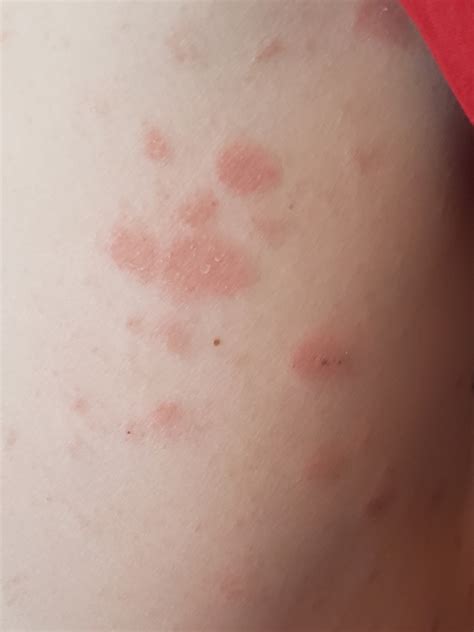 Cannot Figure Out What This Rash Is Dermatology Forums Patient