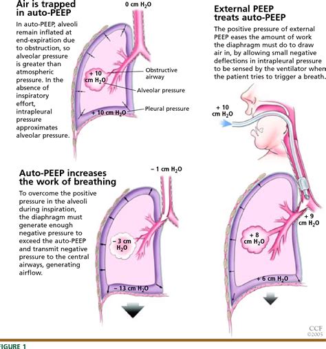 Auto Positive End Expiratory Pressure Mechanisms And Treatment