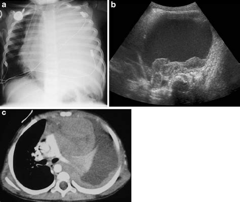 A 3 Year Old Boy With A History Of Treated T Cell Lymphoma That Had