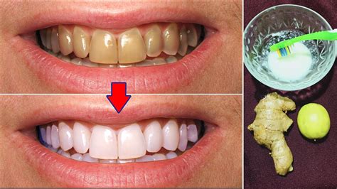 Natural Ways To Whiten Your Teeth At Home In 3 Minutes Magical Teeth