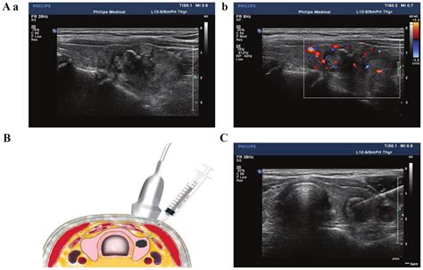 Ultrasound Guided Fine Needle Aspiration Biopsy Of Thyroid Nodules Aa