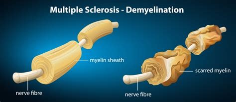Multiple Sclerosis And Neurological Conditions That Affect The Spine