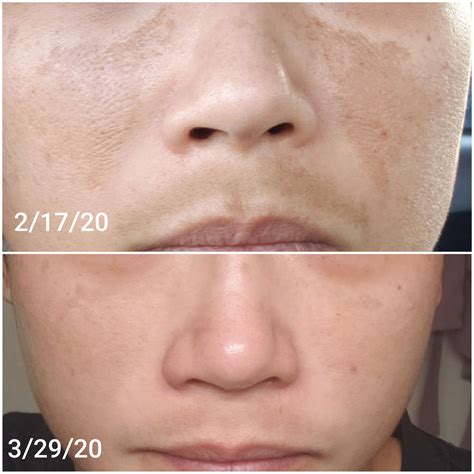 Musely Melasma Reviews Musely Face Rx Cream Review Worth It Or Not