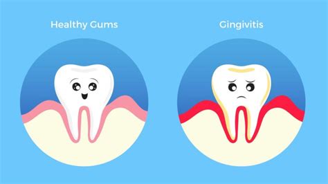Healthy Gums Vs Gingivitis Method Dental