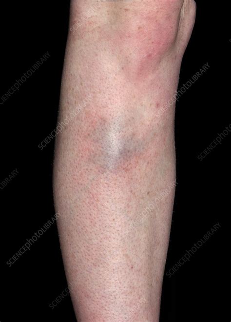 Superficial Phlebitis Stock Image C0532724 Science Photo Library