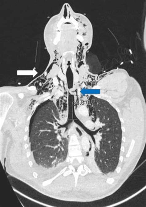 Admission Thoracic Ct Left Anterolateral Tracheal Laceration In The