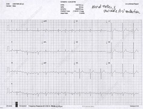 Typical Atrial Flutter And Ecg Salojs