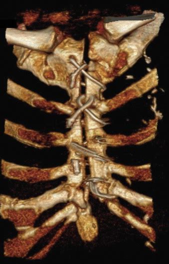 Sternum Popping After Heart Surgery Doctorvisit