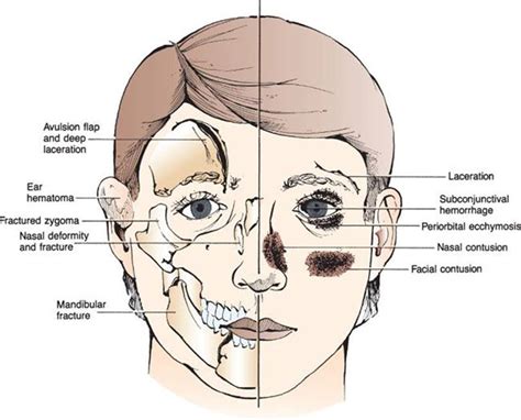 Maxillofacial Injuries Trauma Harwood Nuss Clinical Practice Of