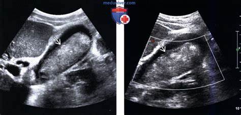 Диета при изменении желчного пузыря