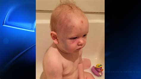 Justiceforjacob Arrest Made After Photos Of Bruised Baby Go Viral Wham