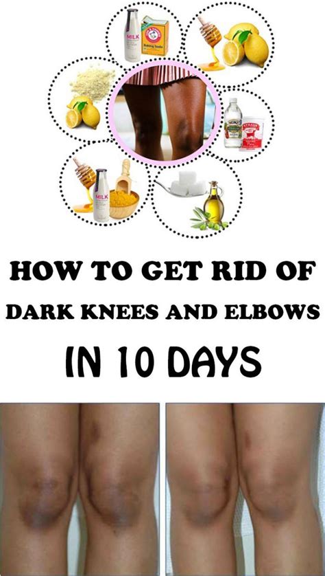 How To Get Rid Of Dark Knees And Elbows In 10 Days Spots On Face