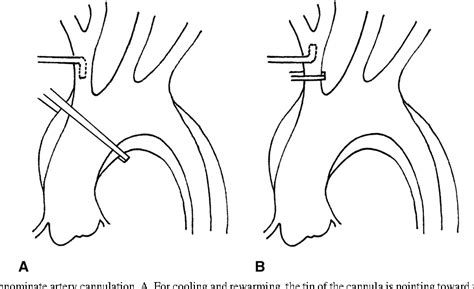 Figure 1 From Repair Of Stanford Type A Aortic Dissection With